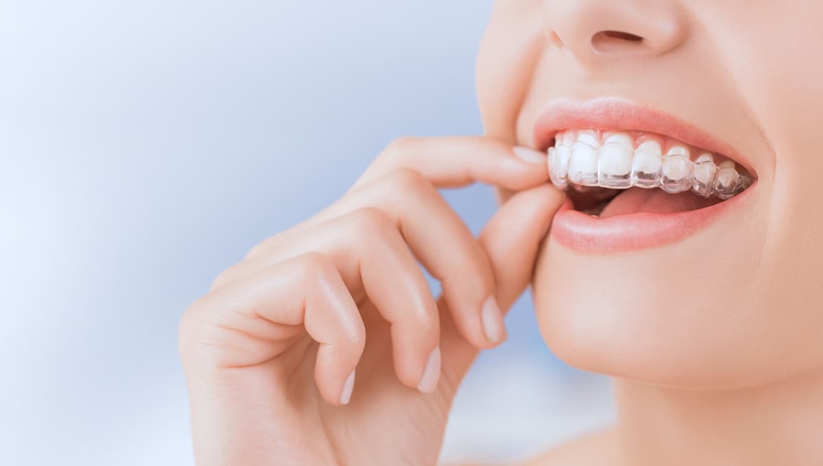 Clear Aligner